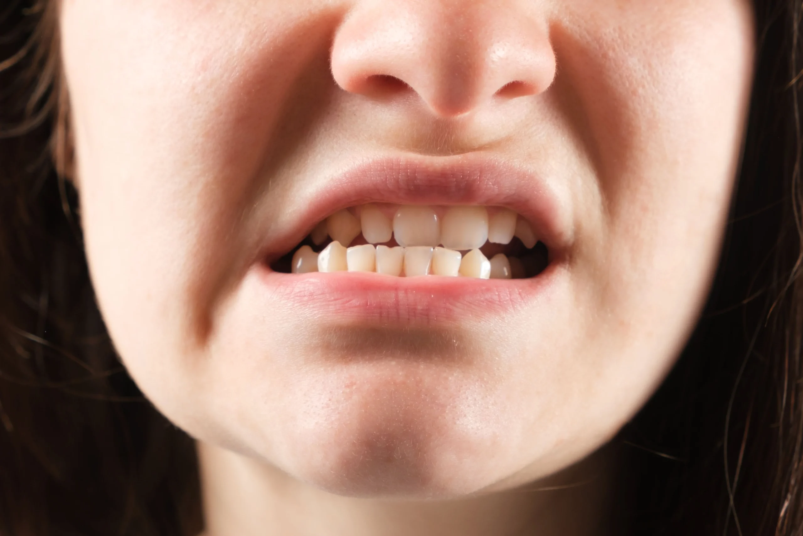 Maloclusiones Y Su Impacto En La Salud Dental ortodoncia en cordoba la sierra