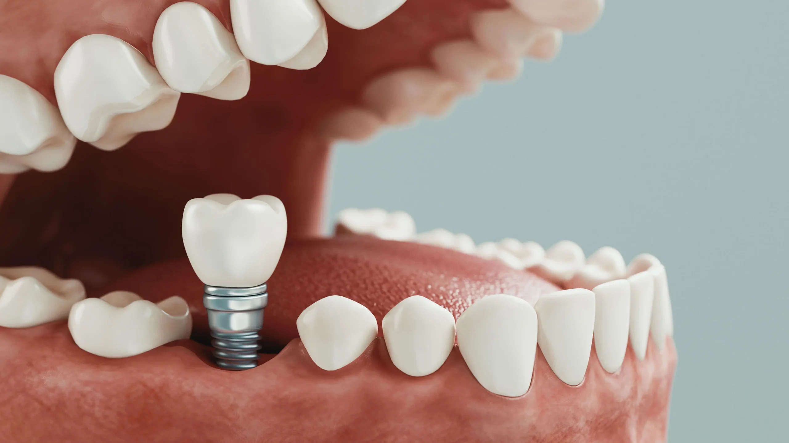 Qué Sucede Si No Reemplazas Un Diente Perdido Con Implantes dentales en cordobba clinica dental la sierra
