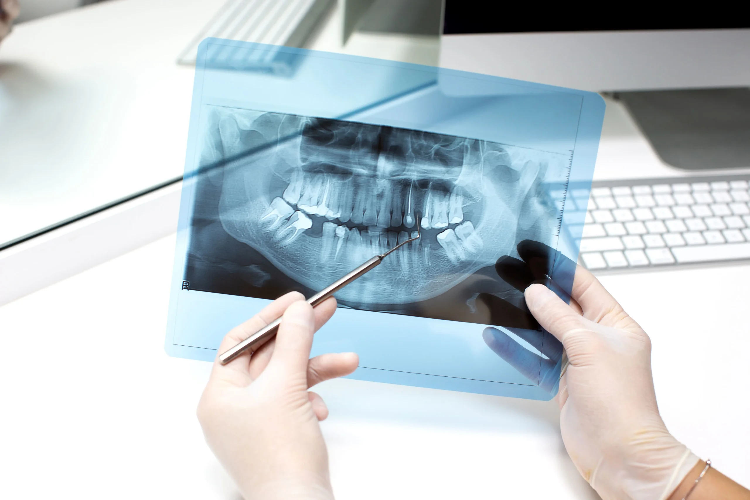 Implantes dentales en cordoba la sierra O Prótesis Dentales Diferencias, Ventajas y Qué Tener En Cuenta